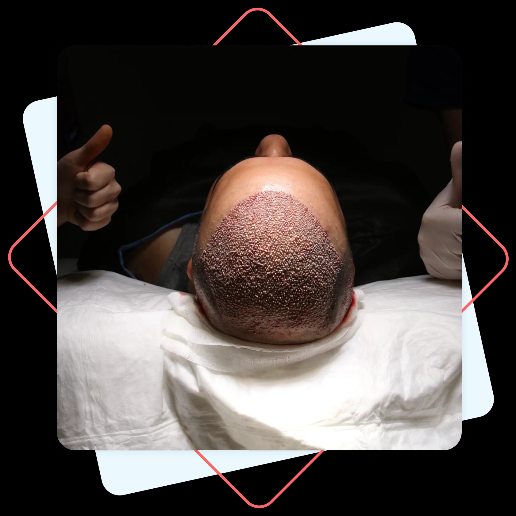 Hair Transplant